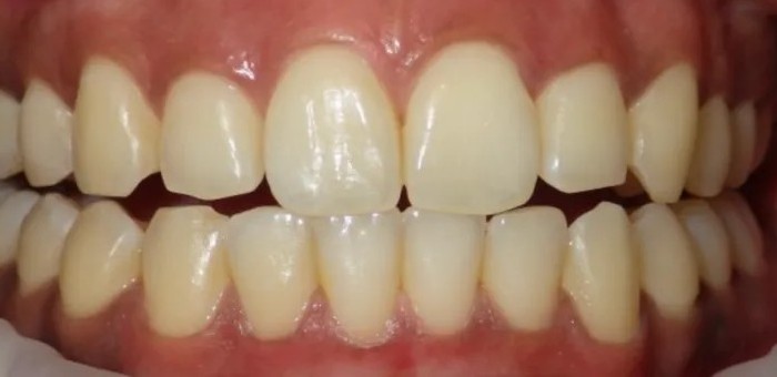 After laser gum depigmentation: lighter, more even pink gums around the same teeth