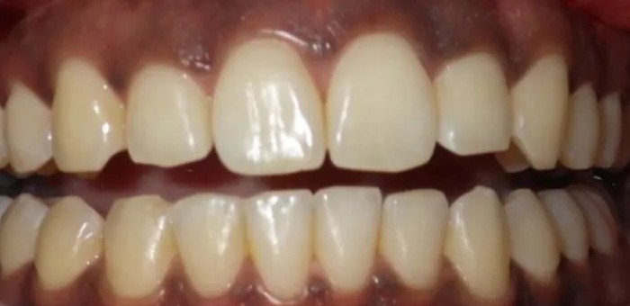 Before laser gum depigmentation: dark pigmentation along the upper and lower gum line