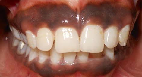 Front teeth with a dark band of natural melanin pigmentation along the upper and lower gum line
