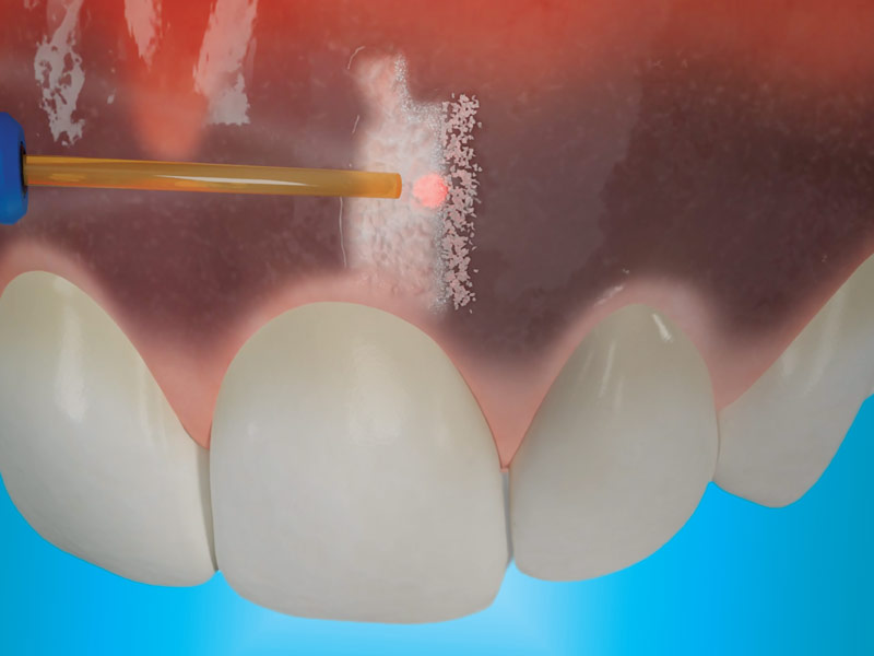 Illustration of a laser fibre tip removing the dark pigmented gum layer above the upper front teeth