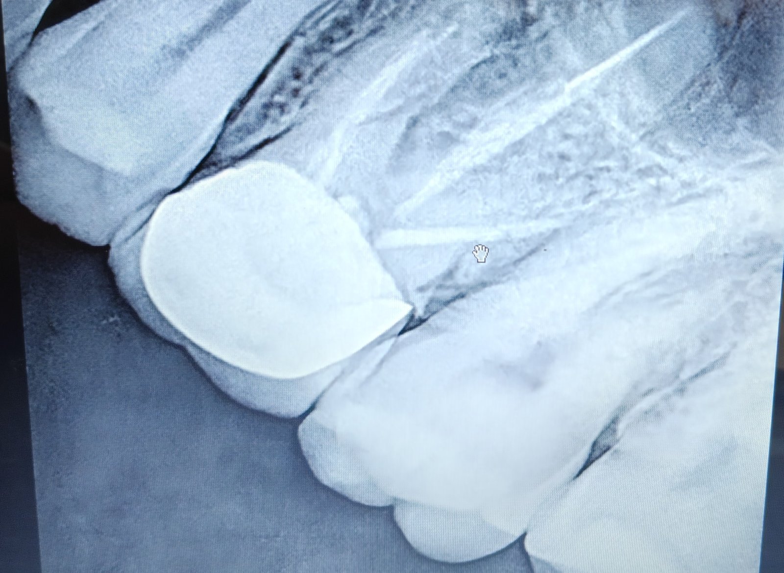 Pre-operative dental X-ray of an upper first molar with a fractured crown and a separated instrument in the palatal root