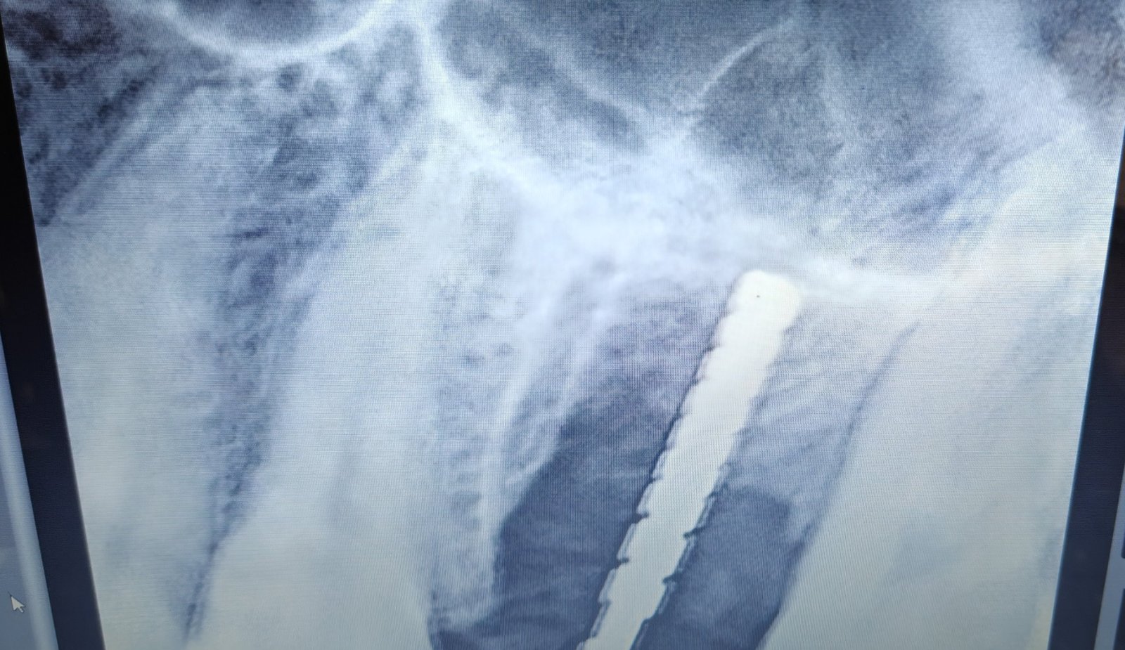 Dental X-ray taken during the indirect sinus lift in the upper molar region