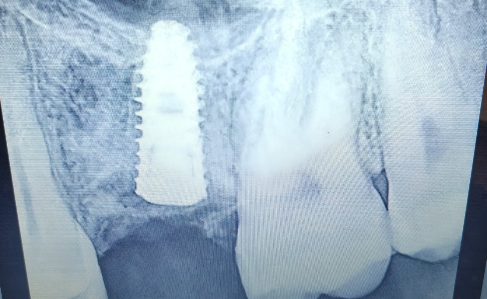 Final dental X-ray after sinus lift and implant placement, showing a dental implant in the upper molar region with grafted bone lifting the sinus floor above it