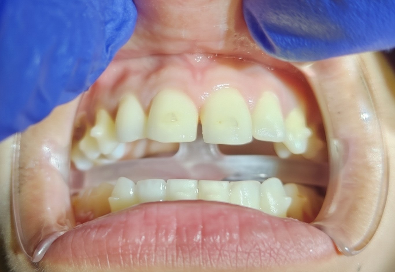 After: frenum released and healed, with smooth tissue between the upper central incisors