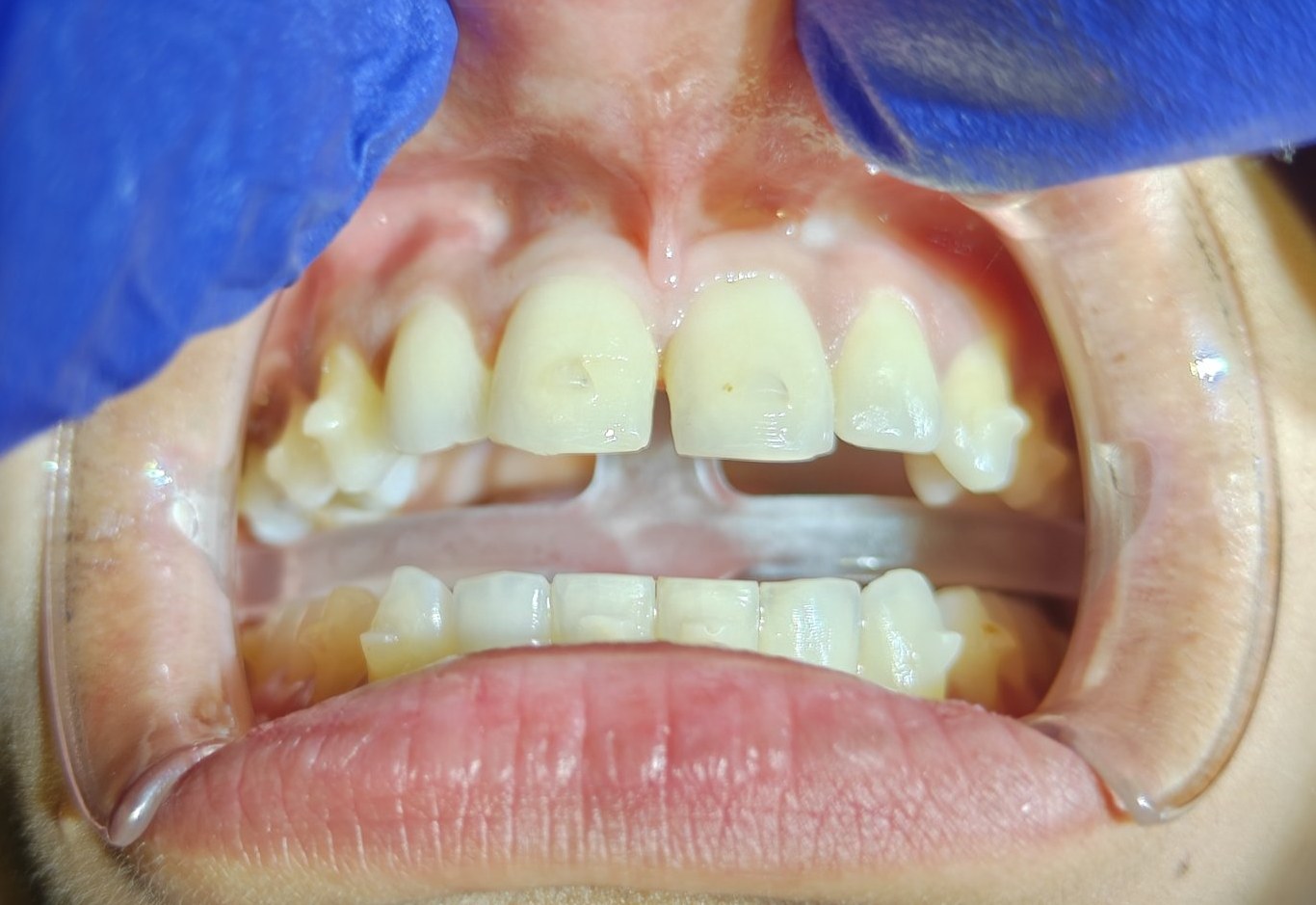 Before: high labial frenum running between the upper central incisors