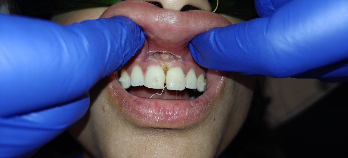 Immediately after laser frenectomy: the frenum released, with the wound area visible above the central incisors
