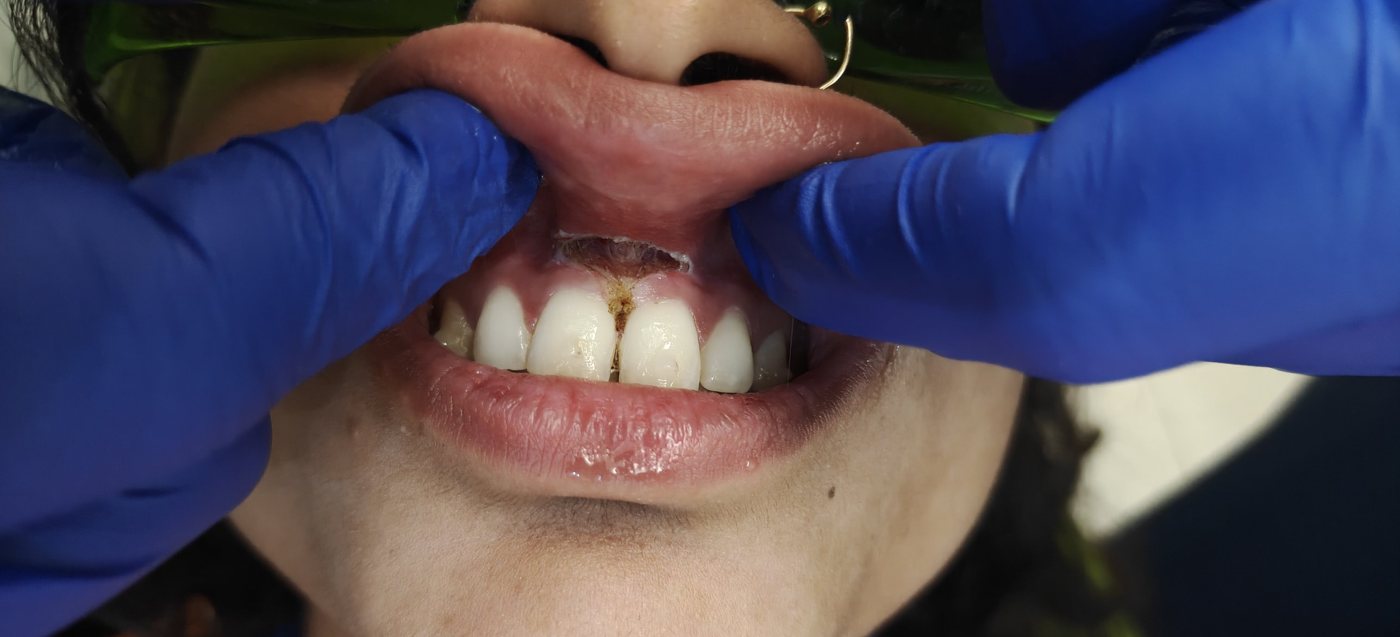 Second view immediately after laser frenectomy