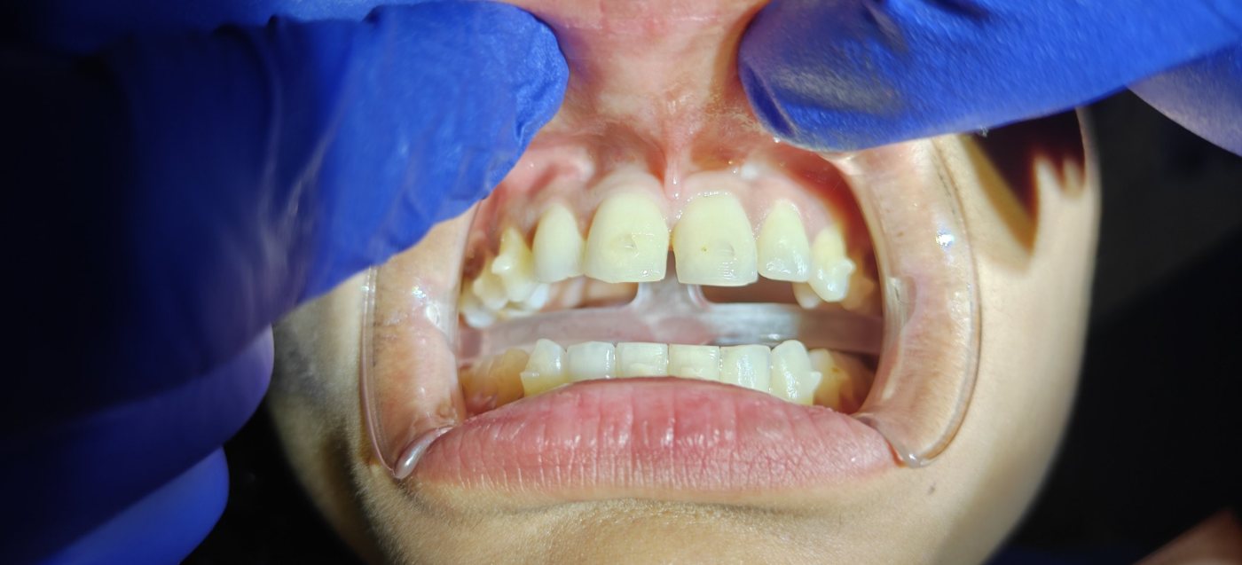 Upper front teeth with lip retracted, showing a high labial frenum and a midline gap before treatment