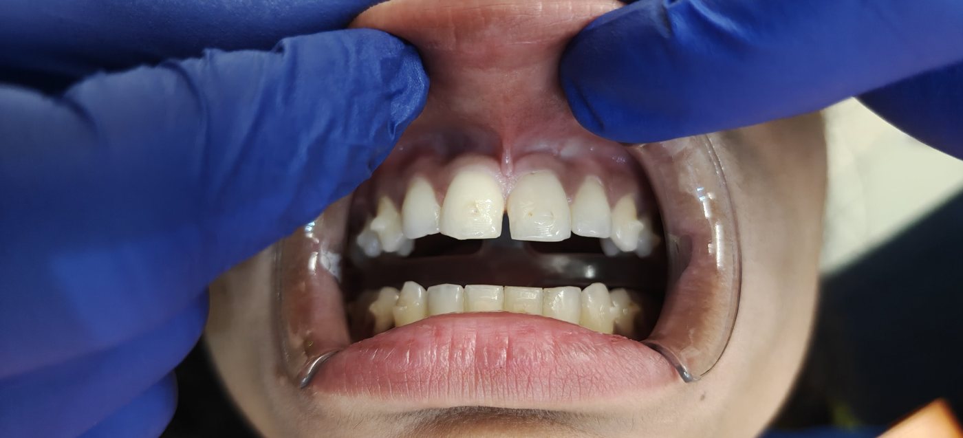 Second pre-treatment view of the midline diastema and frenum attachment