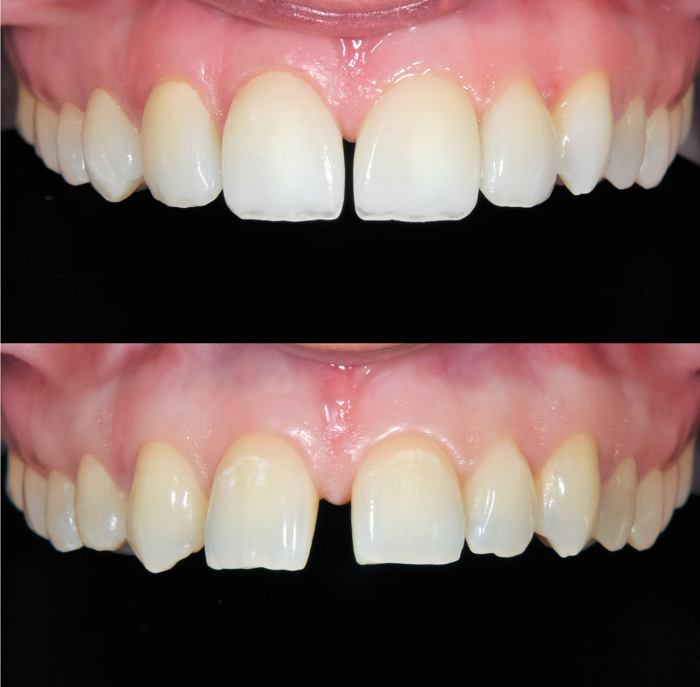 Cosmetic dental veneers