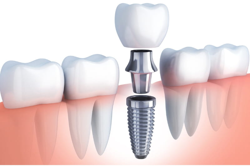 Dental implant treatment at Dental Arch Gurgaon