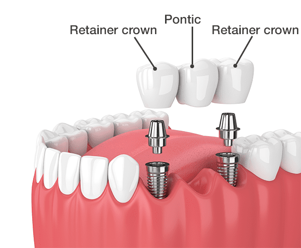 Dental crown and bridge treatment