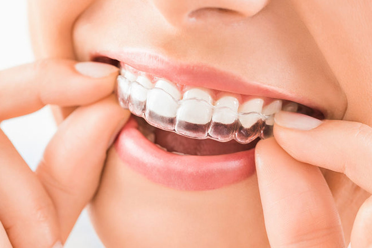 Clear aligners and braces