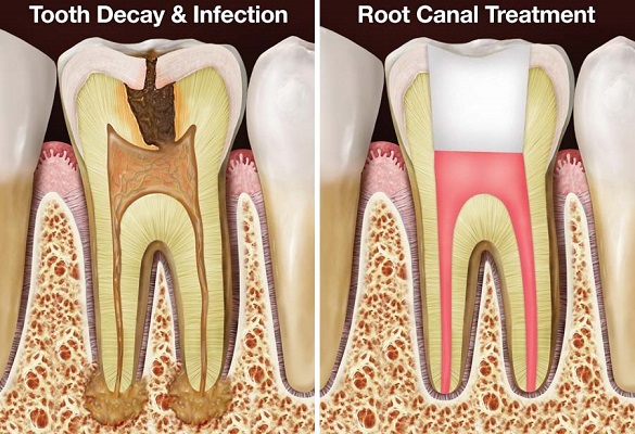 Root canal and general dentistry