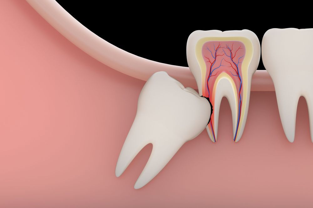 Wisdom tooth and oral surgery